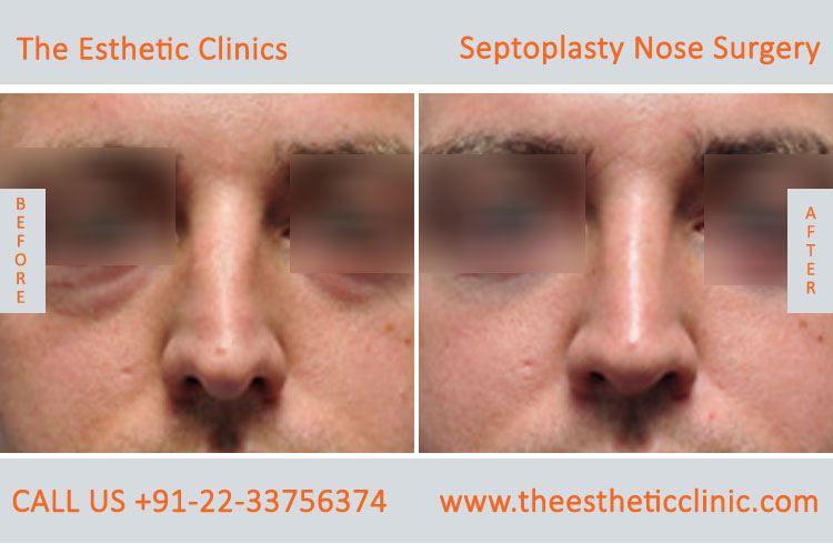 Septoplasty Nose Surgery before after photos in mumbai india (7)